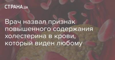 Врач назвал признак повышенного содержания холестерина в крови, который виден любому - strana.ua - Украина - Англия - Швеция