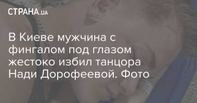 Надежда Дорофеева - Владимир Дантес - Надя Дорофеева - В Киеве мужчина с фингалом под глазом жестоко избил танцора Нади Дорофеевой. Фото - strana.ua - Украина - Киев - Нападение