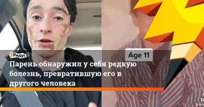 Парень обнаружил у себя редкую болезнь, превратившую его в другого человека - ridus.ru - Индия