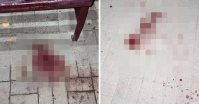 В Бийске незнакомец напал на девушку и раздробил ей камнем лицо - ren.tv - Бийск