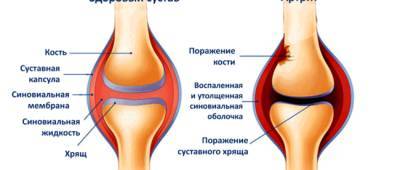 Эксперты рассказали, как защитить суставы осенью - w-n.com.ua