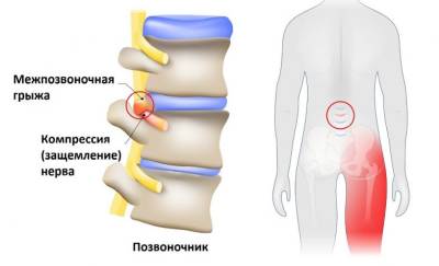 Защемление седалищного нерва: простое лечение в домашних условиях - goodnews.ua