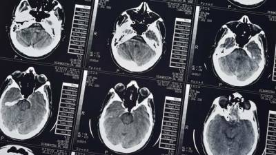Ученые придумали эффективный метод выявления болезни Альцгеймера - iz.ru - Израиль - Каунас