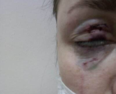 В ХМАО бродячая собака напала на женщину и чуть не лишила ее глаза - znak.com - Ханты-Мансийск - Югра - район Ханты-Мансийский