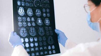 Инсульт, миелит и делирий: вирусолог рассказал, как нейроковид влияет на мозг - vm.ru - Москва