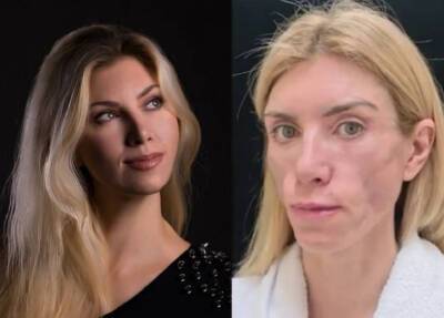 Пластические хирурги изуродовали лицо модели из Сочи и попали под статью - province.ru - Россия - Сочи - Краснодар