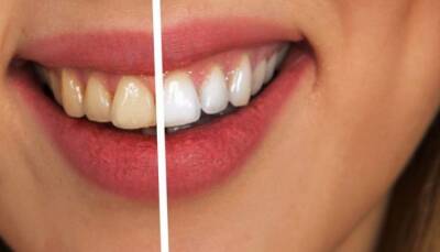 Почему темнеют зубы и как остановить этот процесс - fokus-vnimaniya.com