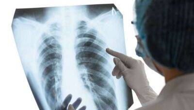 Опасные симптомы туберкулеза перечислили врачи - lenta.ua - Украина