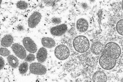 В Праге подтвердили седьмой случай обезьяньей оспы - koronavirus.center - Берлин - Чехия - Португалия - Прага