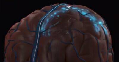 Илон Маск - Опережает Neuralink Илона Маска. В США впервые в мозг человека внедрили постоянный имплант - focus.ua - США - Украина - Нью-Йорк - Нью-Йорк