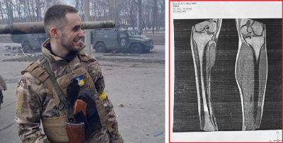 «Зачем ты оставлял ногу» — воин, раненый в Харькове, требует увольнений в МСЭК - objectiv.tv - Украина - Харьков