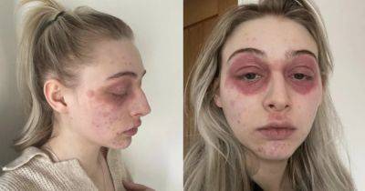 "Как жертва чумы": сильная аллергия на средство для ресниц изуродовала лицо девушки (фото) - focus.ua - Украина - Англия - Великобритания