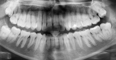 Загадка в полости рта. Стоматологи рассказали, почему у людей есть зубы мудрости - focus.ua - Украина