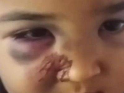 Сам упал. Стали известны подробности инцидента с ребенком, пришедшим в детсад с синяком на лице - podrobno.uz - Узбекистан - Ташкент