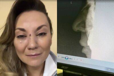 Анна Саливанчук - Беда с женой продюсера "Квартал 95", Анна Саливанчук разбила лицо и сломала нос: кадры из больницы - politeka.net - Украина