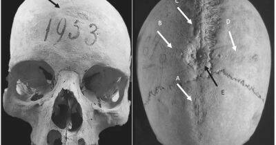 Первая трепанация в истории. Найдены останки женщины из Средневековья с отверстиями в черепе - focus.ua - Украина - Италия - Римская Империя