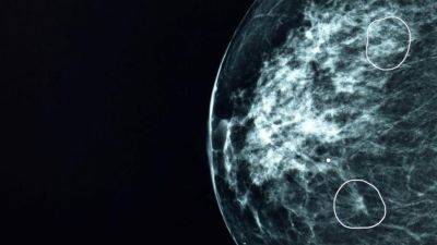 В Британии ИИ помог обнаружить случаи рака груди, пропущенные врачами - gagadget.com - Англия - Microsoft