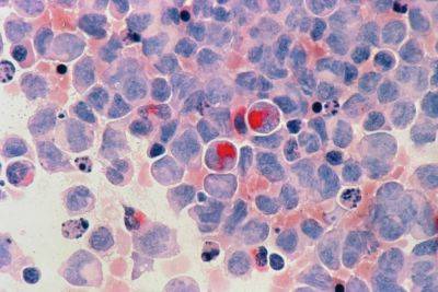 Ученые создали клетку, блокирующую рост раковых опухолей - cursorinfo.co.il - Хельсинки